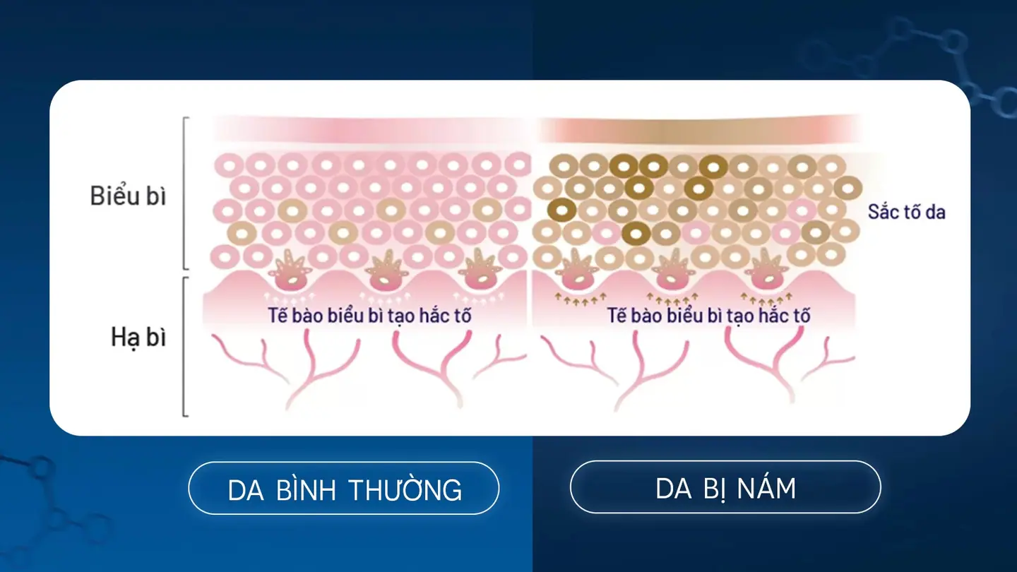 Trị nám tế bào gốc NovaBeauty 