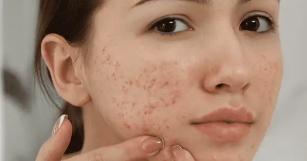 Sẹo rỗ do mụn viêm để lại trên da