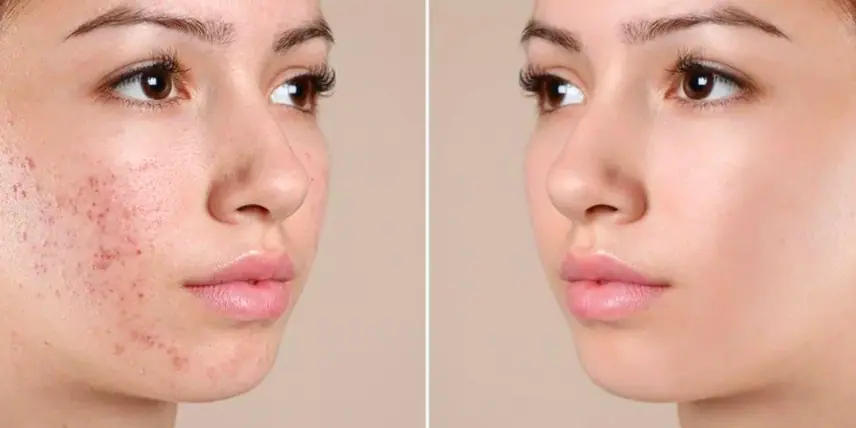 Ảnh: Trị mụn đồng thời với tái tạo da rút ngăn thời gian phục hồi