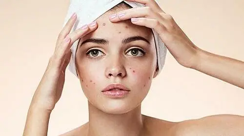 Viêm da khiến các bạn nữ thiếu tự tin