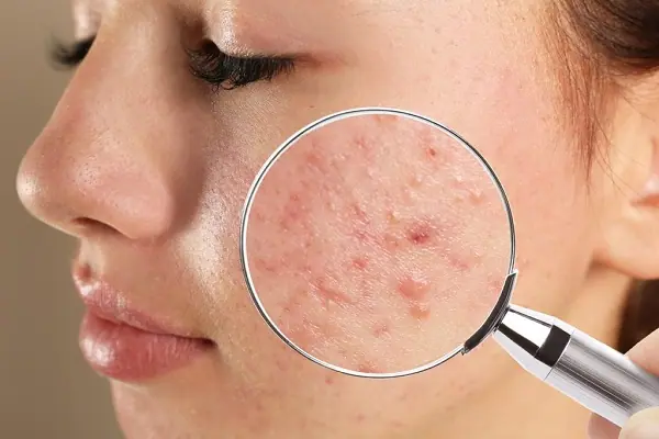 Mụn viêm gây mất thẩm mỹ và khó điều trị triệt để bằng cách thông thường