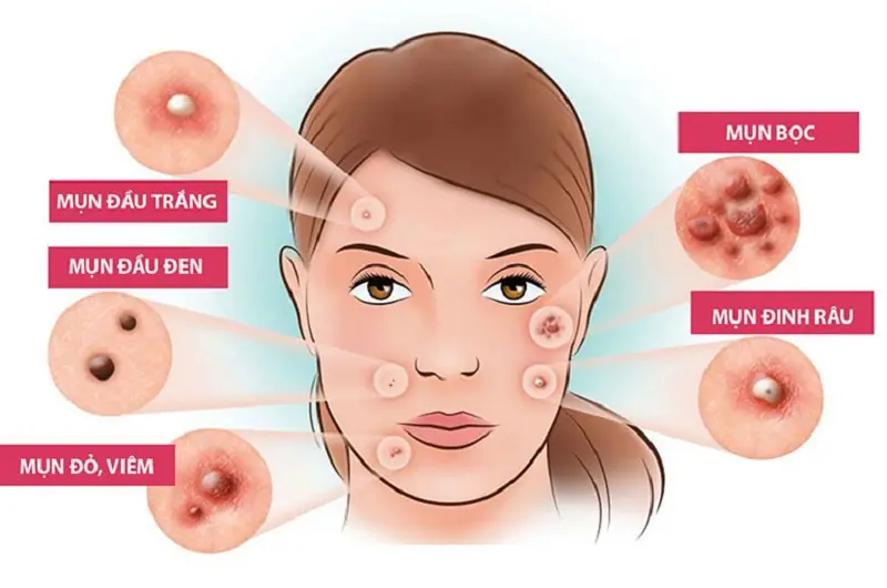 các loại mụn trên mặt
