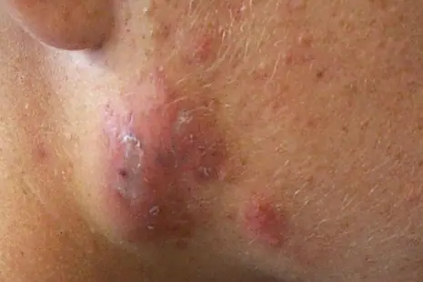Mụn viêm nang