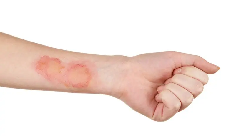 Hình ảnh da bị nhiễm trùng