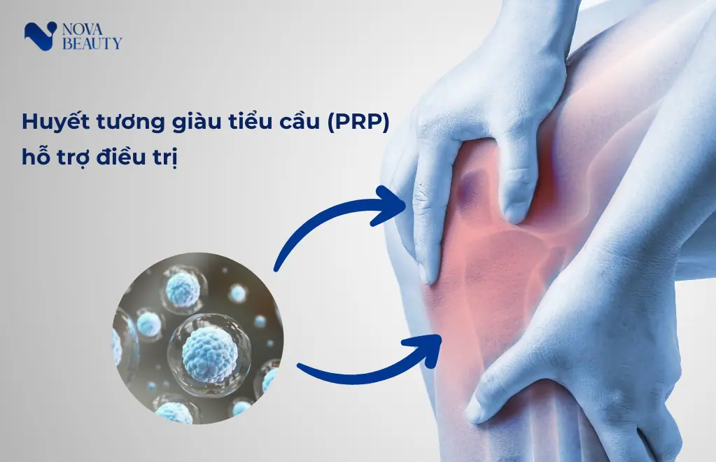 PRP Plus - Giải pháp an toàn chữa trị thoái hoá khớp hiện nay