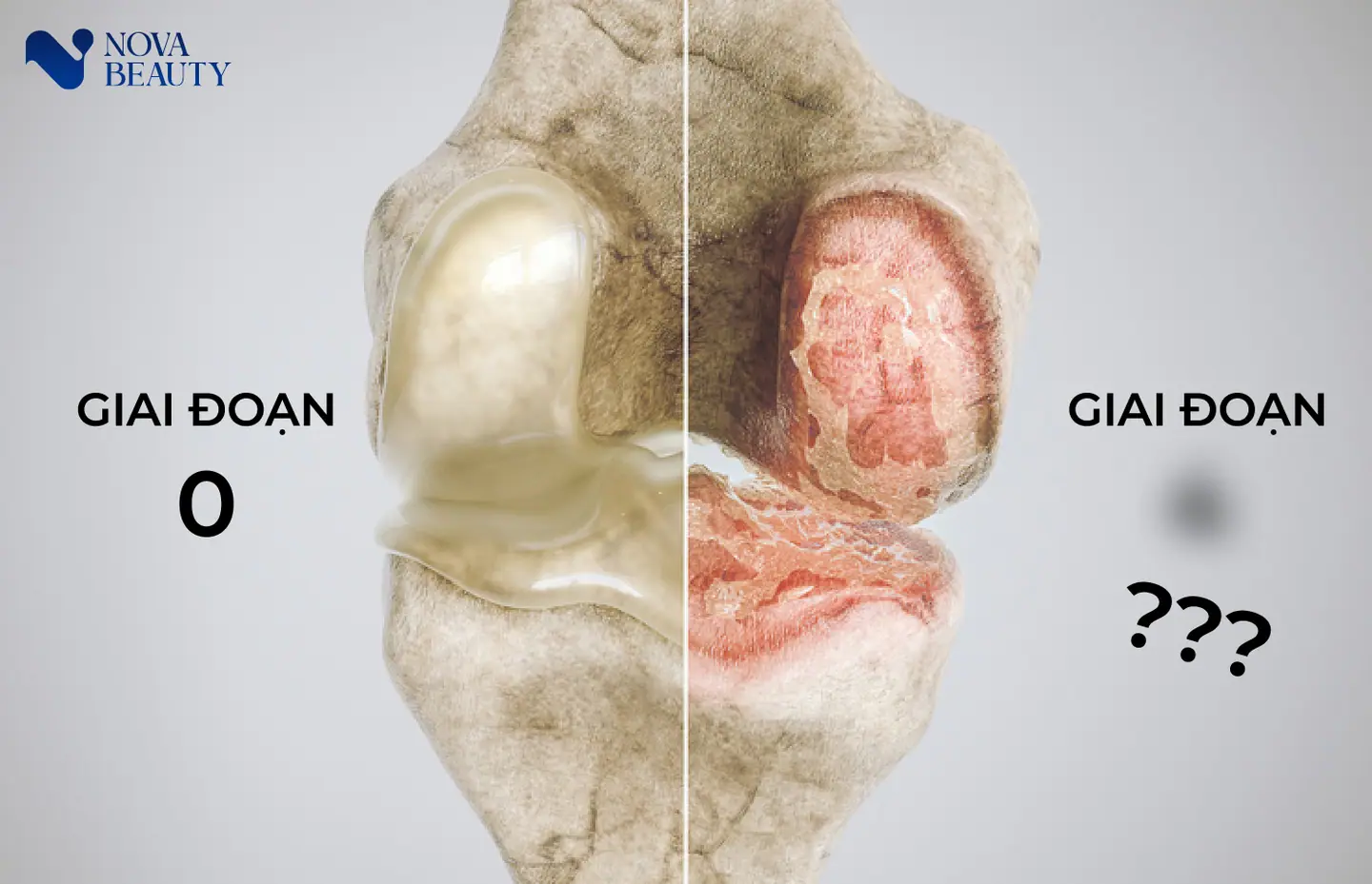 Các giai đoạn thoái hoá khớp